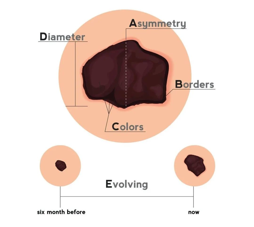 长成这样的痣和色斑，是黑色素瘤的预备军？