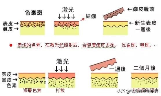 激光祛斑后反黑，是正常现象还是复发了？该怎么办？