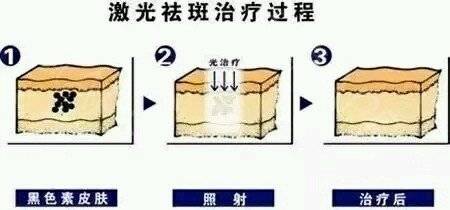 我做完激光祛斑竟然反黑？会黑多久啊？