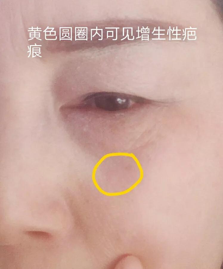 "药水点斑"究竟好不好？点斑一年以后的我用真实的效果来告诉你