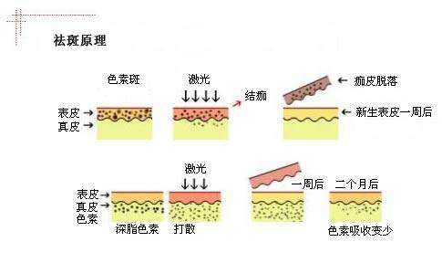 老年斑激光能一次祛除吗，激光除斑越除越黑？该怎么选，怎么做，才能安全又有效