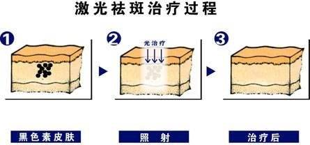 痘痘、斑点“突然”成功消失，原来她在假期里偷偷······