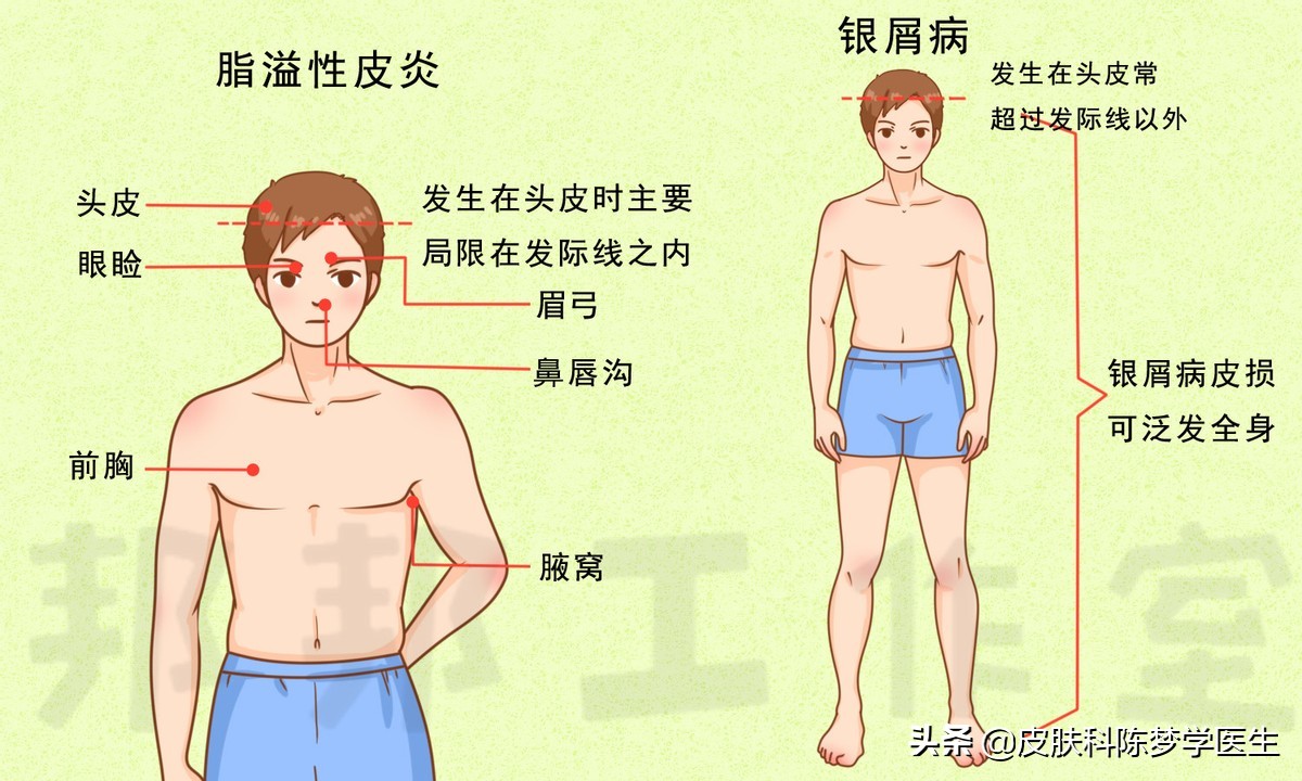 脸上长红斑、脱屑，是银屑病还是脂溢性皮炎？