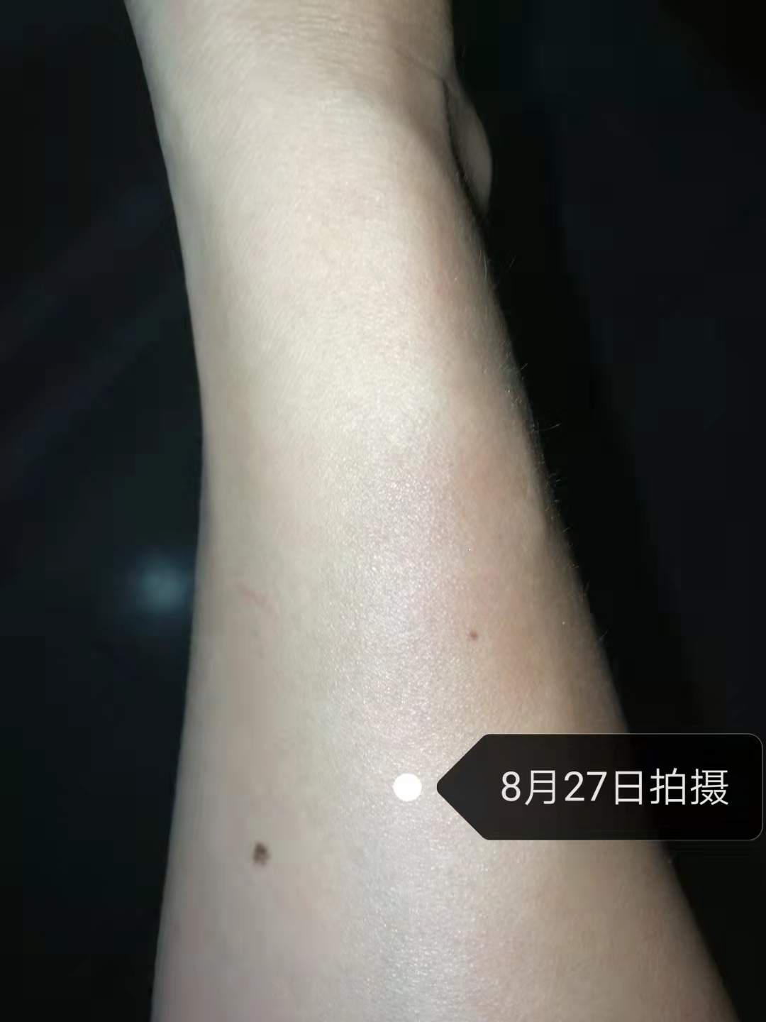 轻揉淤血斑之后每天的变化