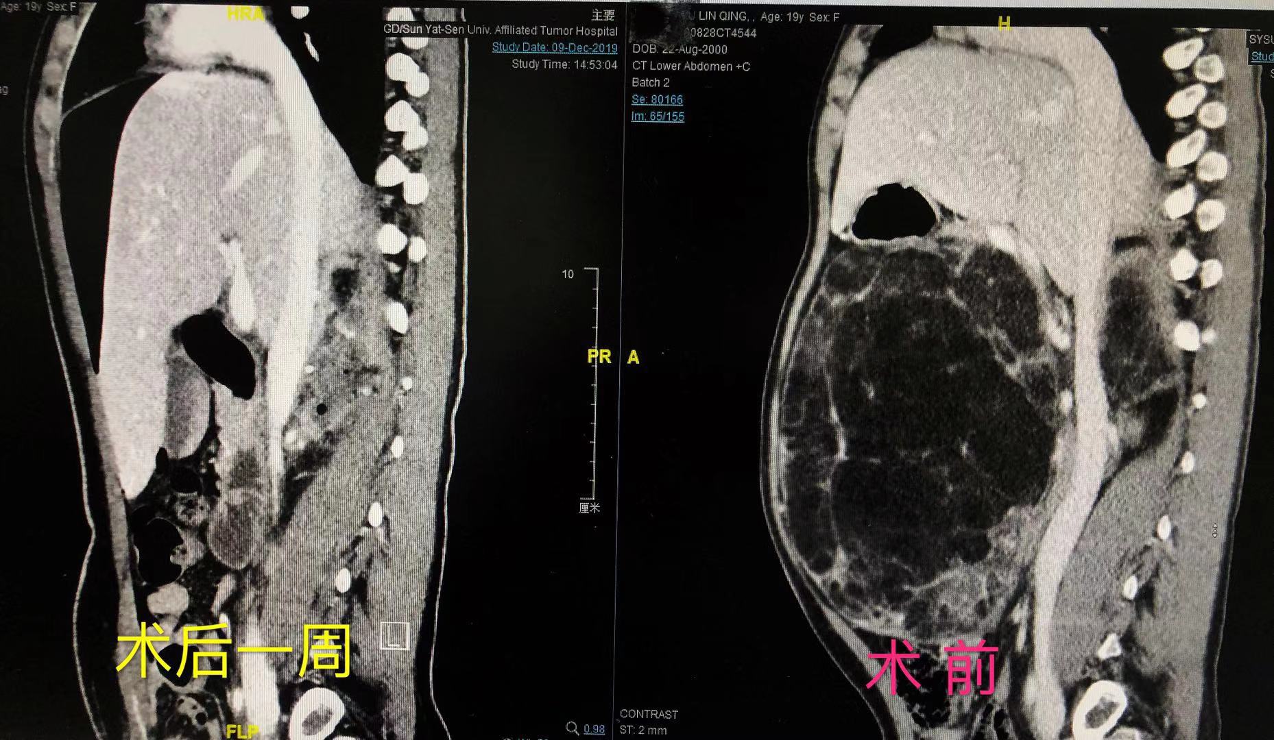 惊讶！19岁女孩脸长蝴蝶斑，肚大如萝，竟然是罕见遗传病