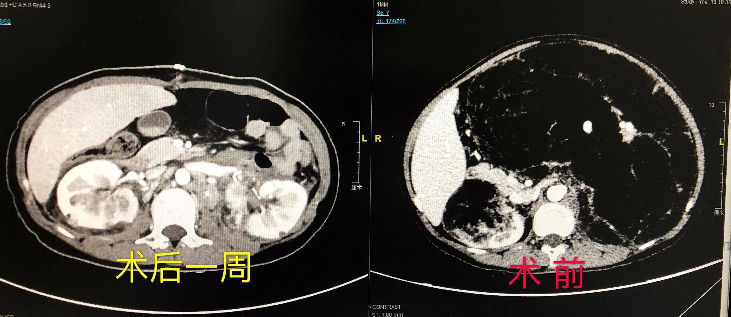 惊讶！19岁女孩脸长蝴蝶斑，肚大如萝，竟然是罕见遗传病