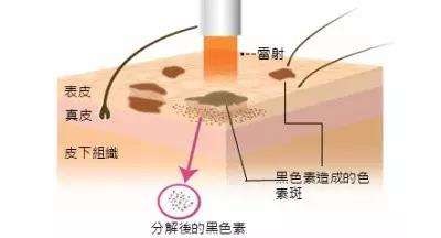 为什么我总是长斑？激光祛斑真有效果么？