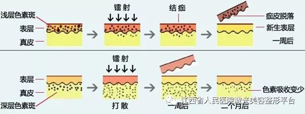 做了激光祛斑后，皮肤反而更黑了！这是为什么呢？