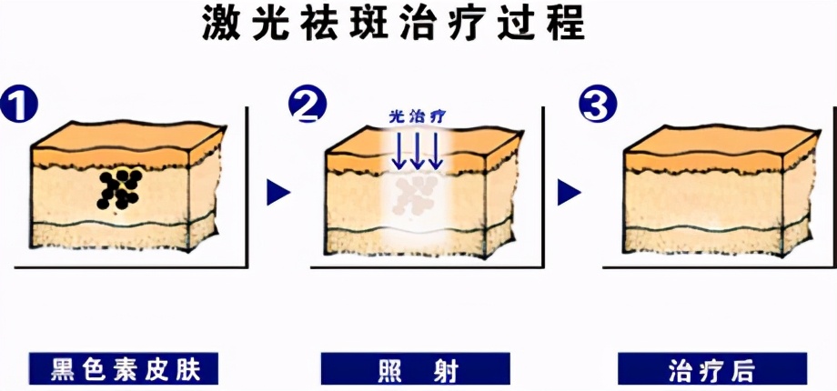 超全激光祛斑术后注意事项，还有这些人不适合激光祛斑