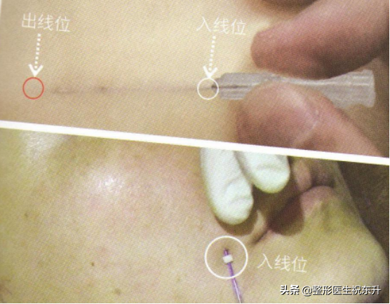 线雕能和注射、激光类的项目一起做吗？听听医生怎么说...