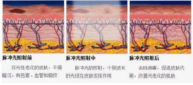 激光去雀斑需要做几次