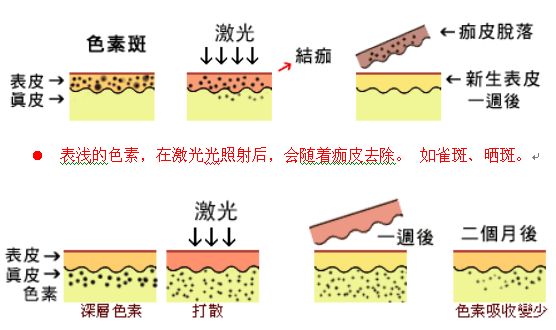 激光去雀斑需要做几次