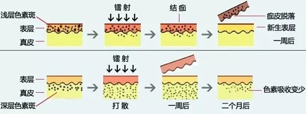 光子嫩肤反黑后怎样恢复？