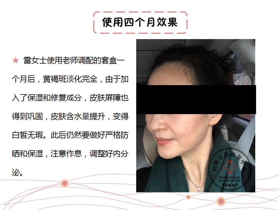 ST修复中心：激光反黑怎么办？看这篇就够了