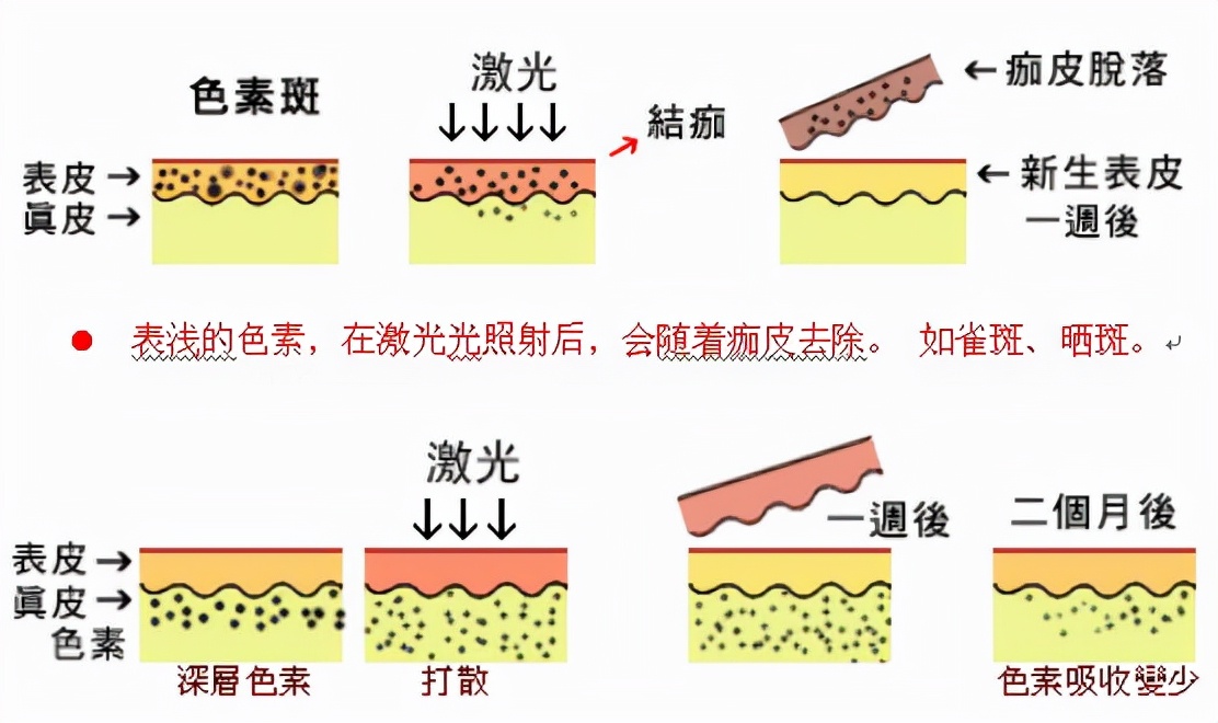 轻医美界的“扛把子”项目：皮秒是如何祛斑的？容易复发吗？