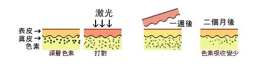 激光去斑后我“后悔了” 实际上这些都是暂时性的