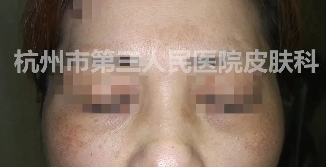 名医在身边丨杭州一女子斥巨资激光祛斑却成“大花脸”！专家：这些“坑”不要再踩