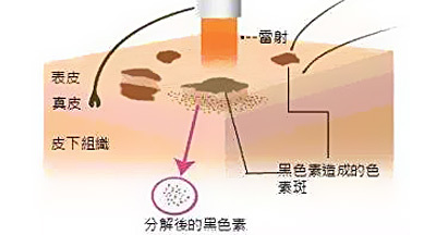 如何正确祛斑