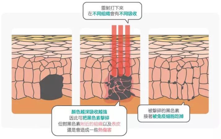 激光治疗黄褐斑靠谱吗？