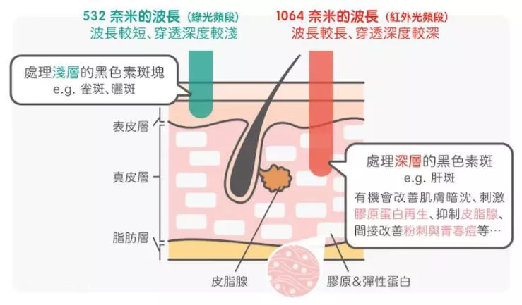 激光治疗黄褐斑靠谱吗？