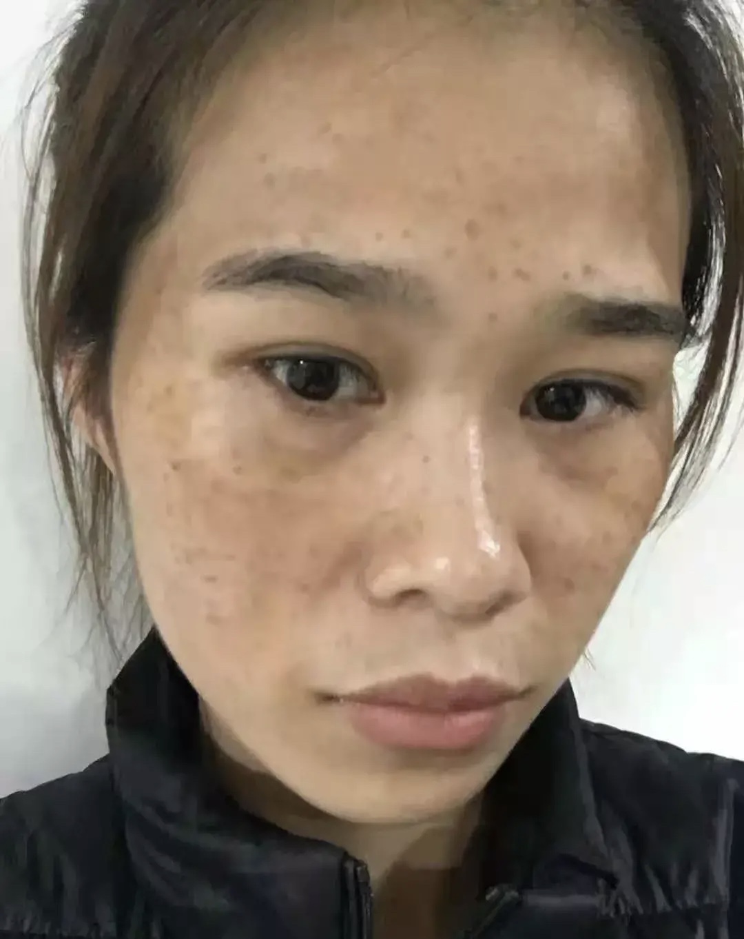 还为脸上的斑发愁吗？听听祛斑女孩5年经验，拒绝花冤枉钱