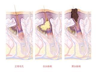 痘印痘坑如何安全修复？中国医学科学院皮肤科医师来告诉你