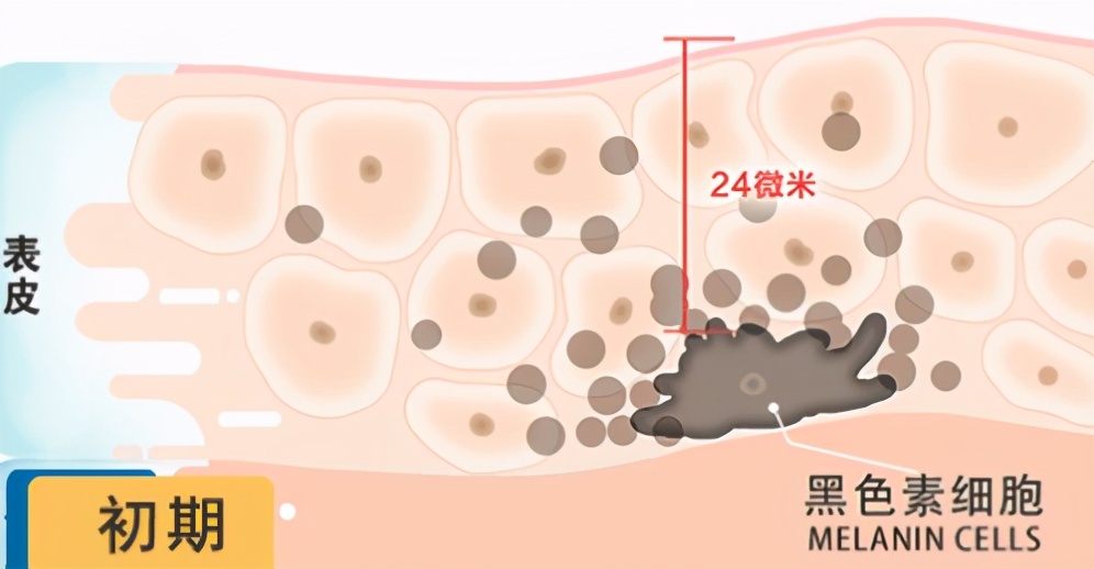 激光祛斑图片，激光祛斑法有效吗？黄褐斑用什么祛除？-今日头条