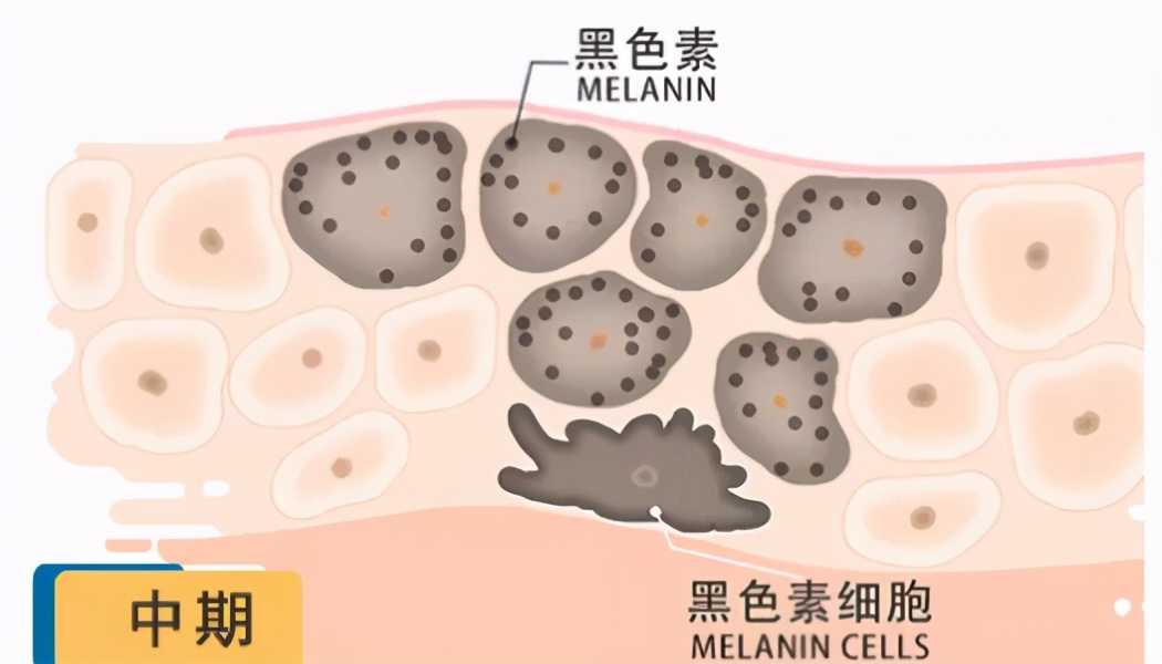 激光祛斑法有效吗？黄褐斑用什么祛除？