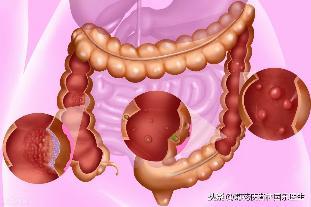 脸上突然长黑斑图片，嘴唇、脸上、指尖长黑斑说明什么？不要轻视！警惕黑斑息肉病