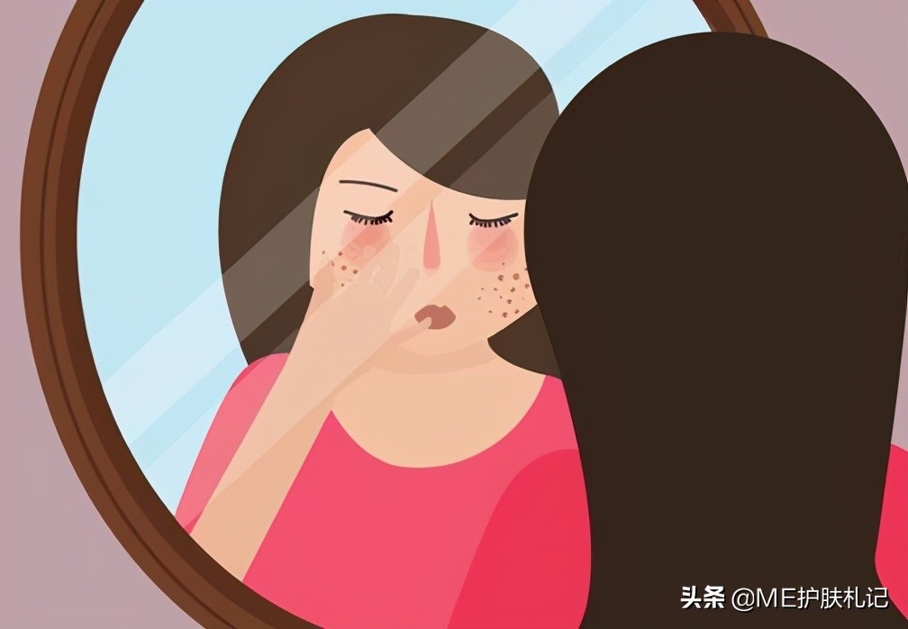 ME胶原蛋白科普：13种不同的色斑，你能分得清吗？