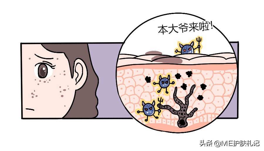 ME胶原蛋白科普：13种不同的色斑，你能分得清吗？