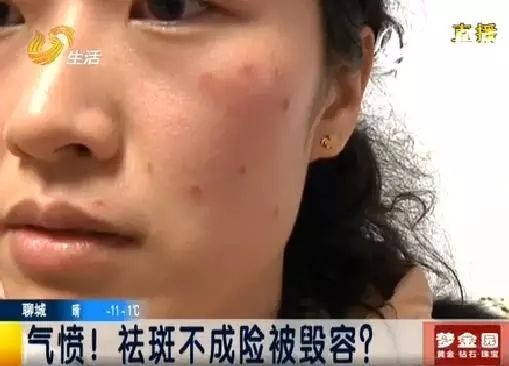 雀斑去不掉？不存在的！看完这篇就懂了！