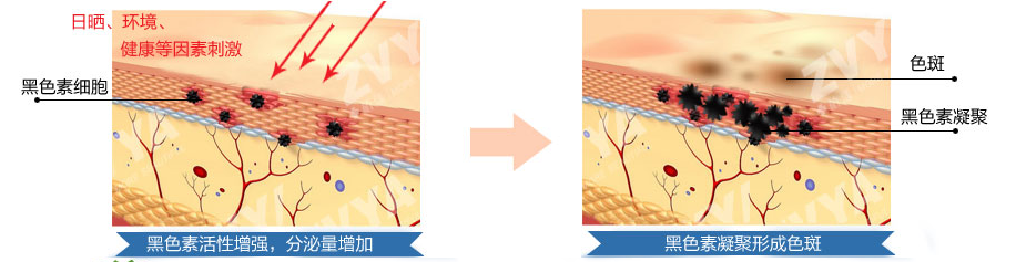 预防+根治=彻底祛斑，阻断长斑根源，代谢斑点色素