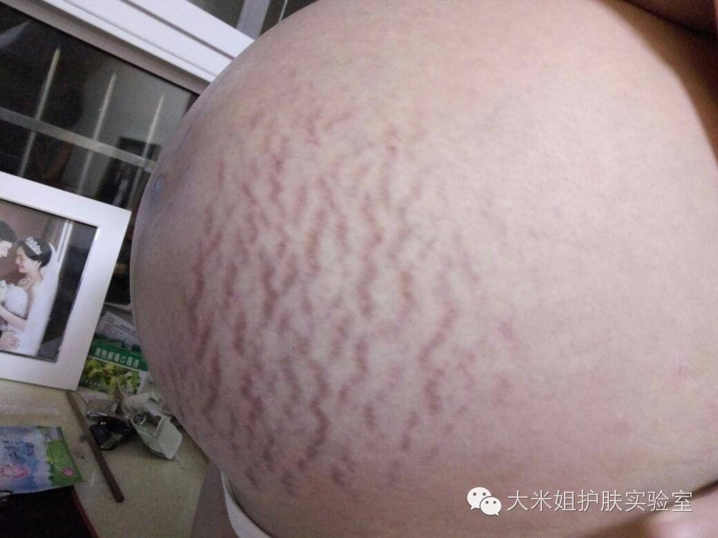 孕妇可以用美白淡斑产品吗，孕期真的就不能护肤吗？至少含这些成份的护肤品别用！